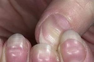 Восстановление здоровья ногтей после шеллака